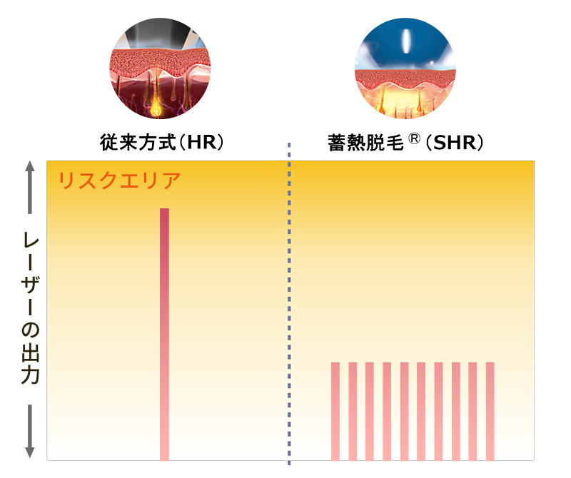 蓄熱脱毛出力